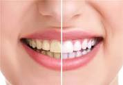 تغذیه مناسب یکی از عوامل پیشگیری از پوسیدگی دندان می باشد