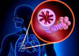 آسم، یکی از معضلات اصلی نظام سلامت