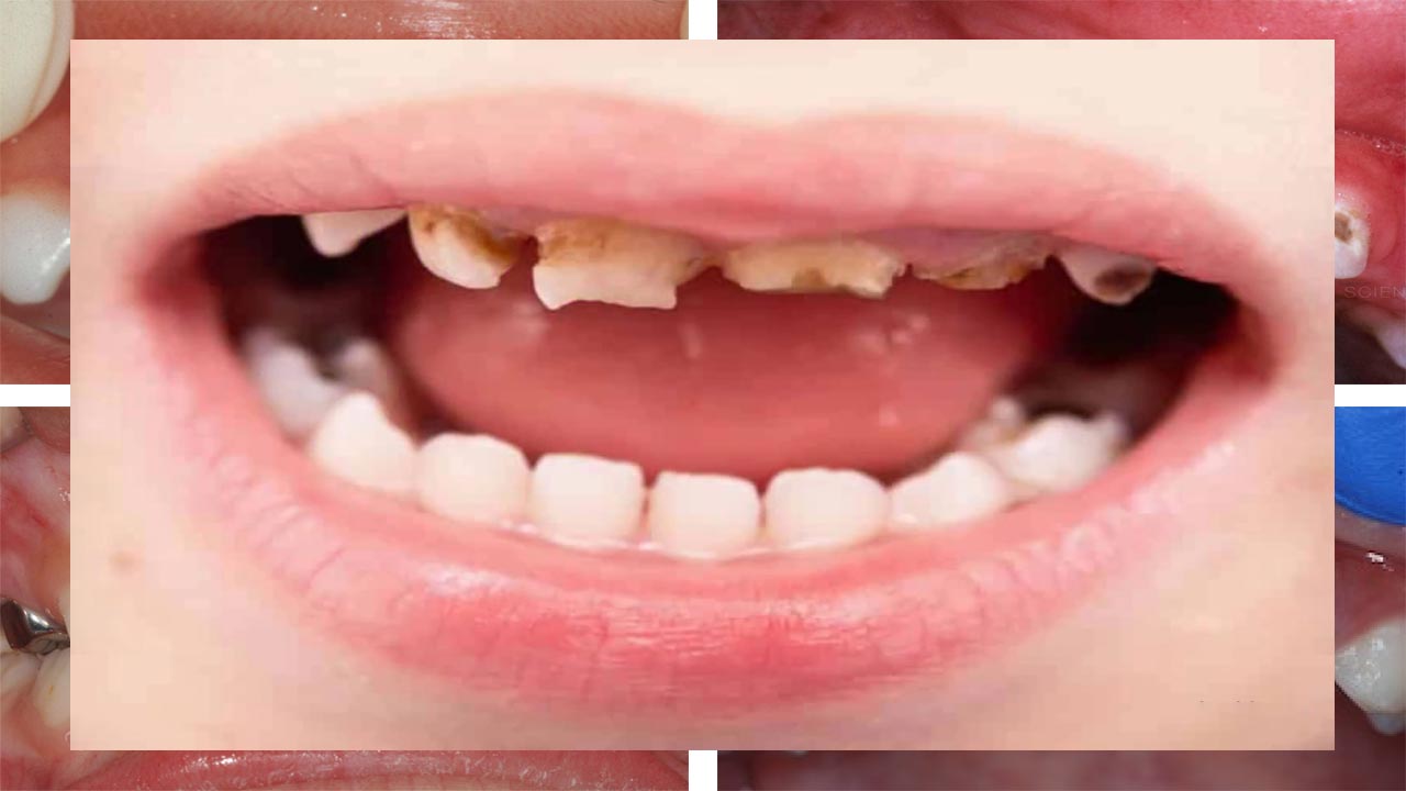 اثرات مخرب خوراکی ها بر روی دندان ها