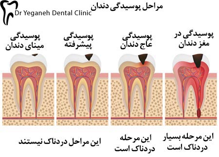 همه چیز درباره پوسیدگی دندان