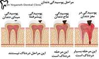 همه چیز درباره پوسیدگی دندان