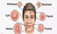 اقداماتی برای درمان آکنه