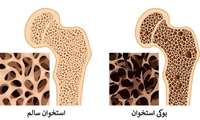 پوکی استخوان در سالمندان